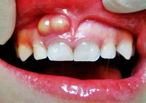 apse yapan dişe ne iyi gelir