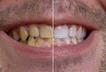 diş beyazlatma yöntemleri